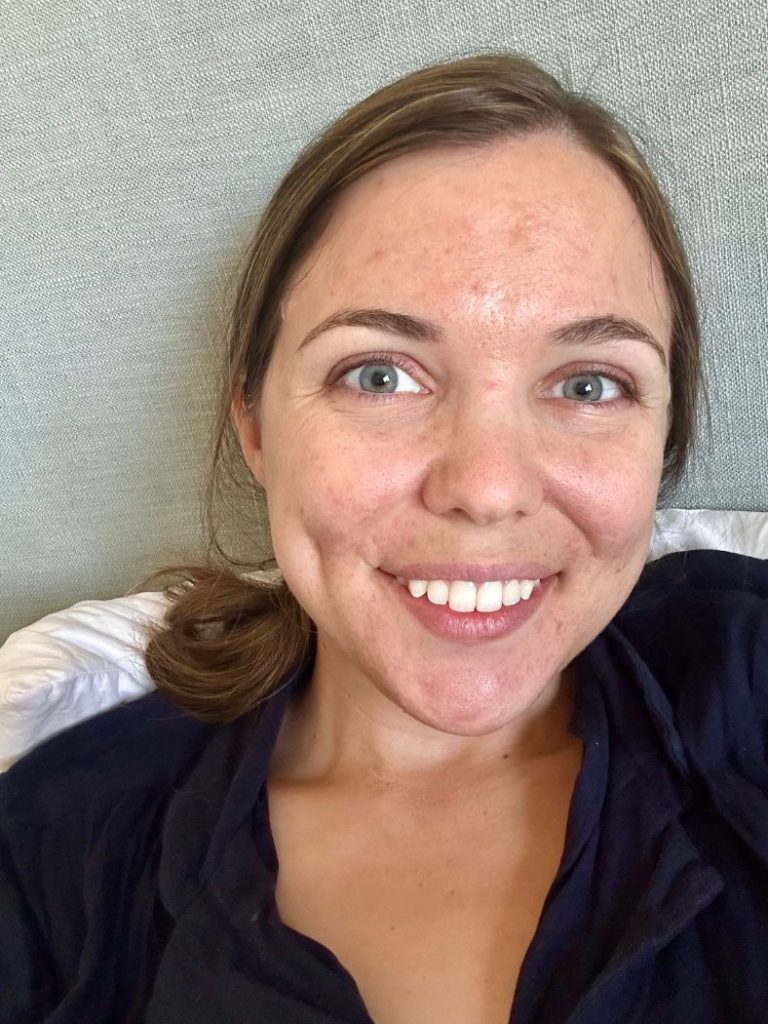 Close-up of facial skin texture with active acne breakouts before skincare treatment